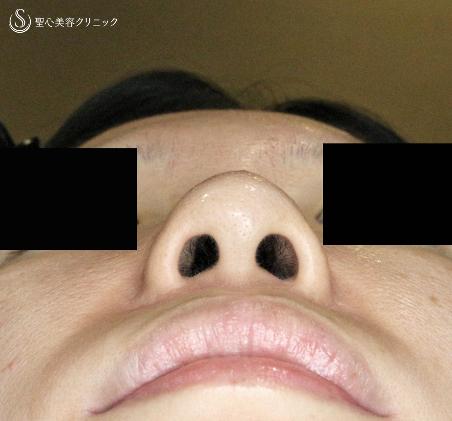 【20代女性・三角形に張り出した特徴的な小鼻をスマートに】小鼻縮小術+α法「Ver.4」単独例（2年7ヶ月） After 