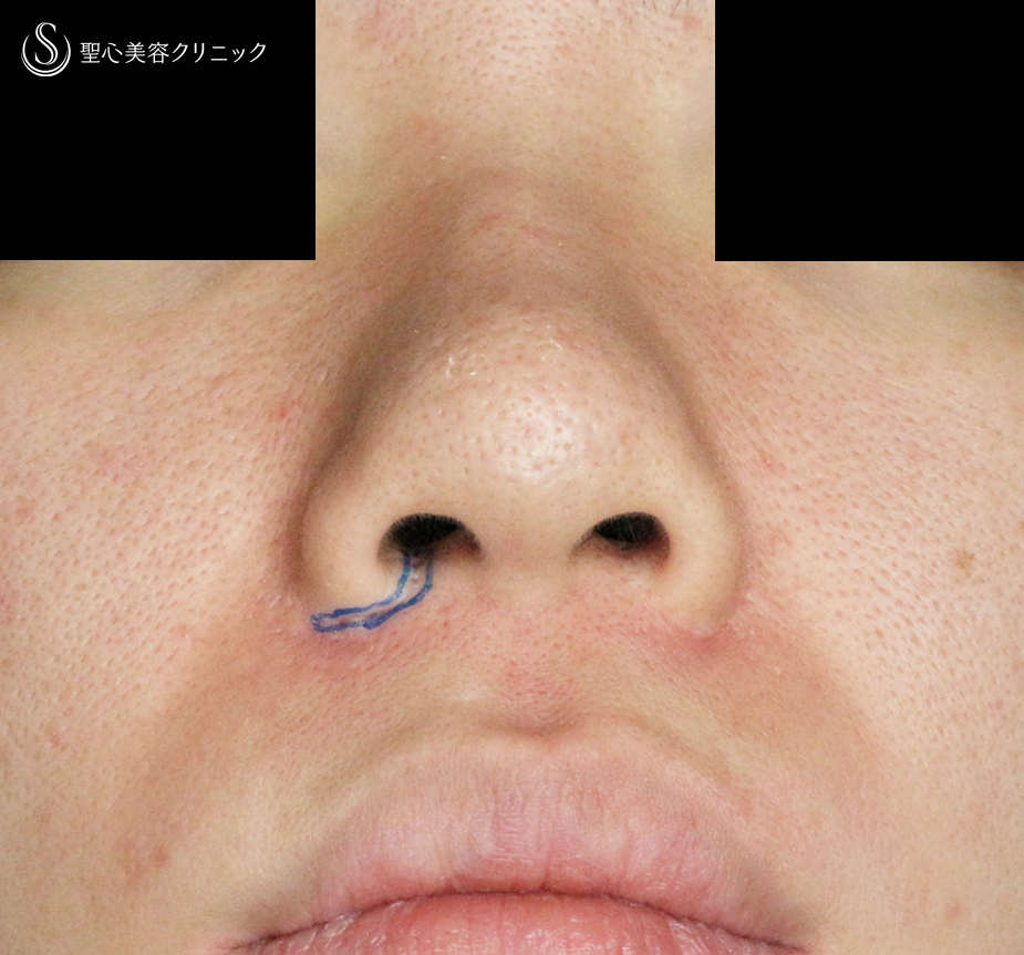 【20代女性・三角形に張り出した特徴的な小鼻をスマートに】小鼻縮小術+α法「Ver.4」単独例（2年7ヶ月） After 