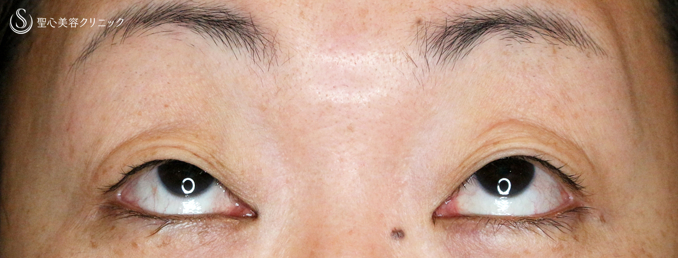 【40代女性・コンタクトレンズによる眼瞼下垂】切らない眼瞼下垂+α法（1ヶ月後） Before 