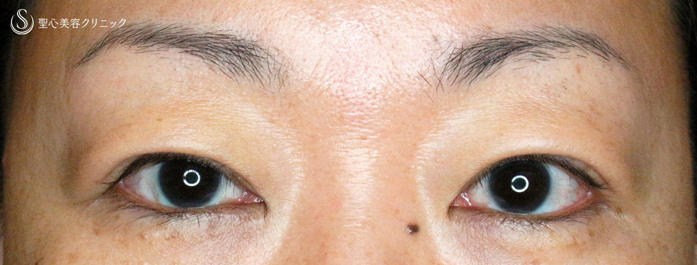 【40代女性・コンタクトレンズによる眼瞼下垂】切らない眼瞼下垂+α法（1ヶ月後） After 