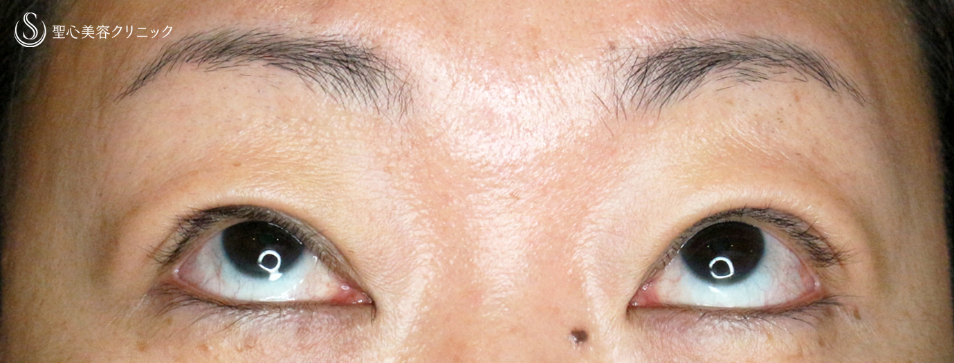 【40代女性・コンタクトレンズによる眼瞼下垂】切らない眼瞼下垂+α法（1ヶ月後） After 