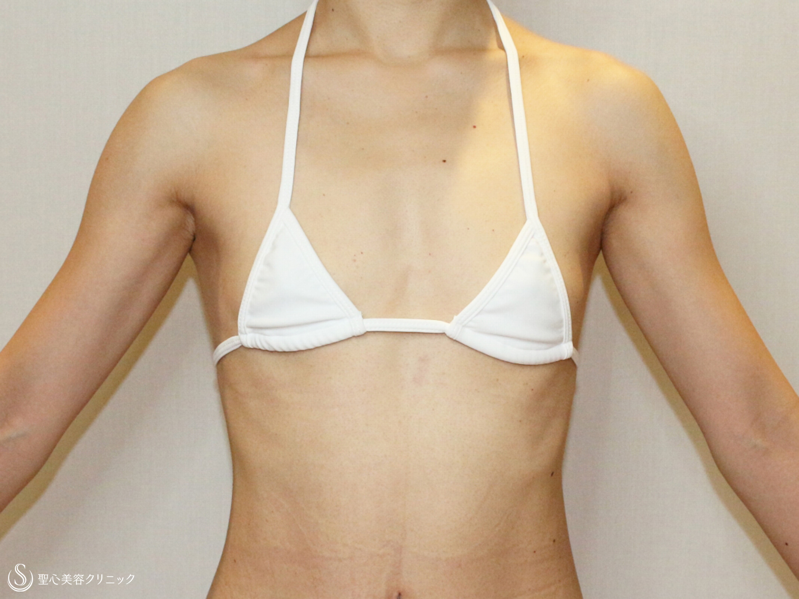 【30代女性・自分の脂肪でバストアップ】プレミアム・セリューション豊胸術（6ヶ月後） Before 