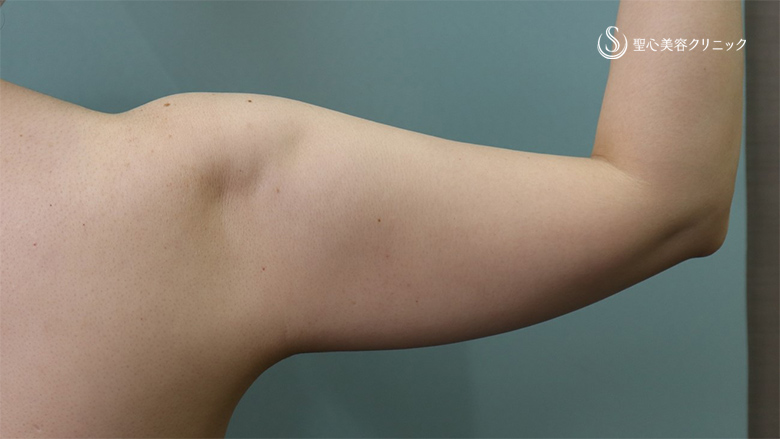 【40代女性・二の腕痩身】ベイザーリポ2.2脂肪吸引（術後1か月） Before 