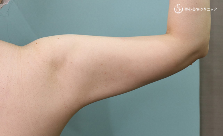 【40代女性・二の腕痩身】ベイザーリポ2.2脂肪吸引（術後1か月） After 