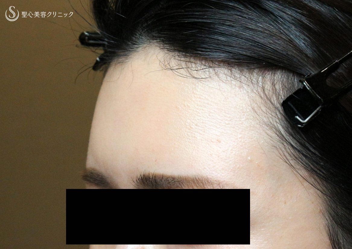 【30代女性・女性のオデコを丸くする】プレミアムPRP皮膚再生療法（直後〜3ヶ月後） After 
