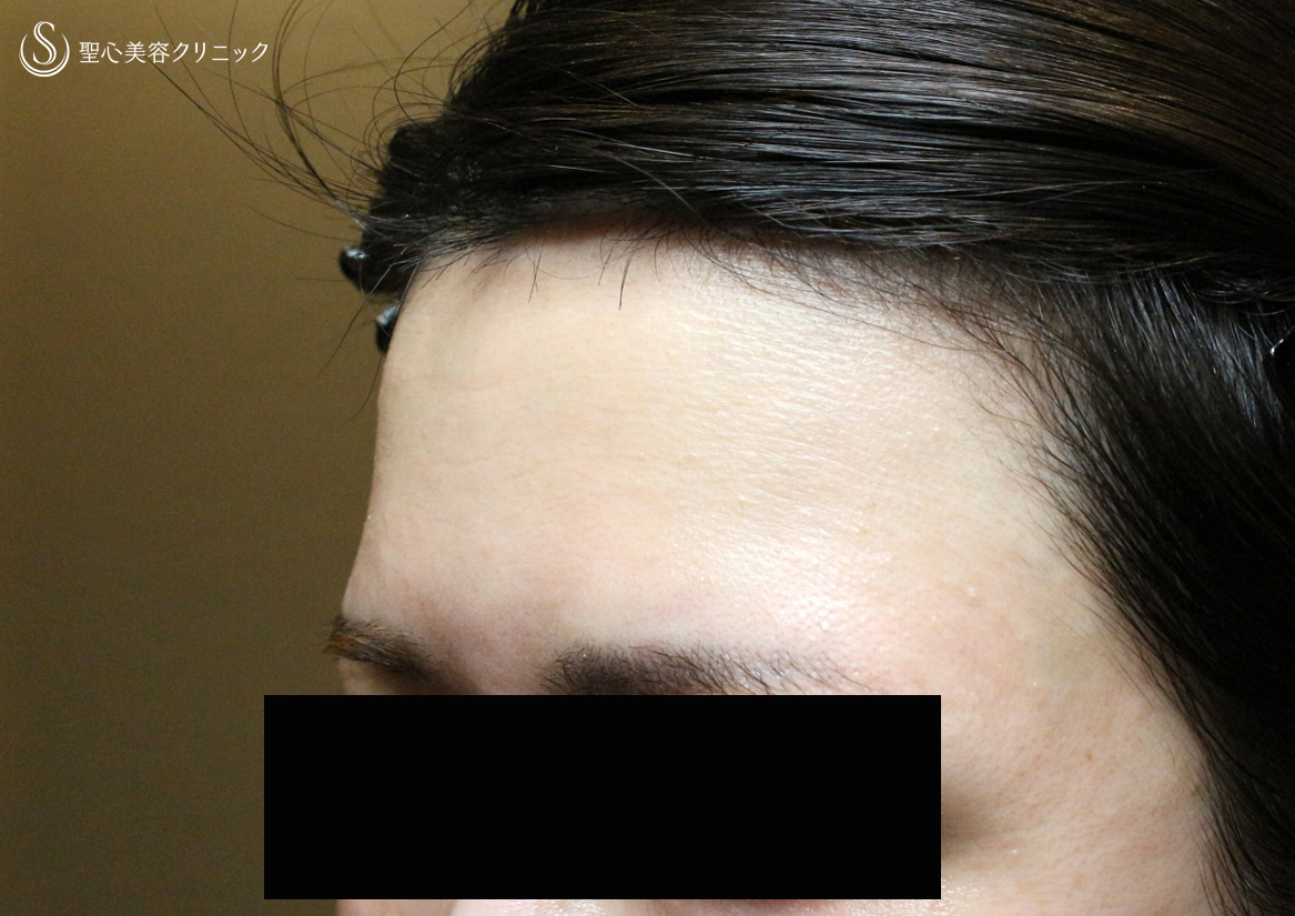 【30代女性・女性のオデコを丸くする】プレミアムPRP皮膚再生療法（直後〜3ヶ月後） Before 