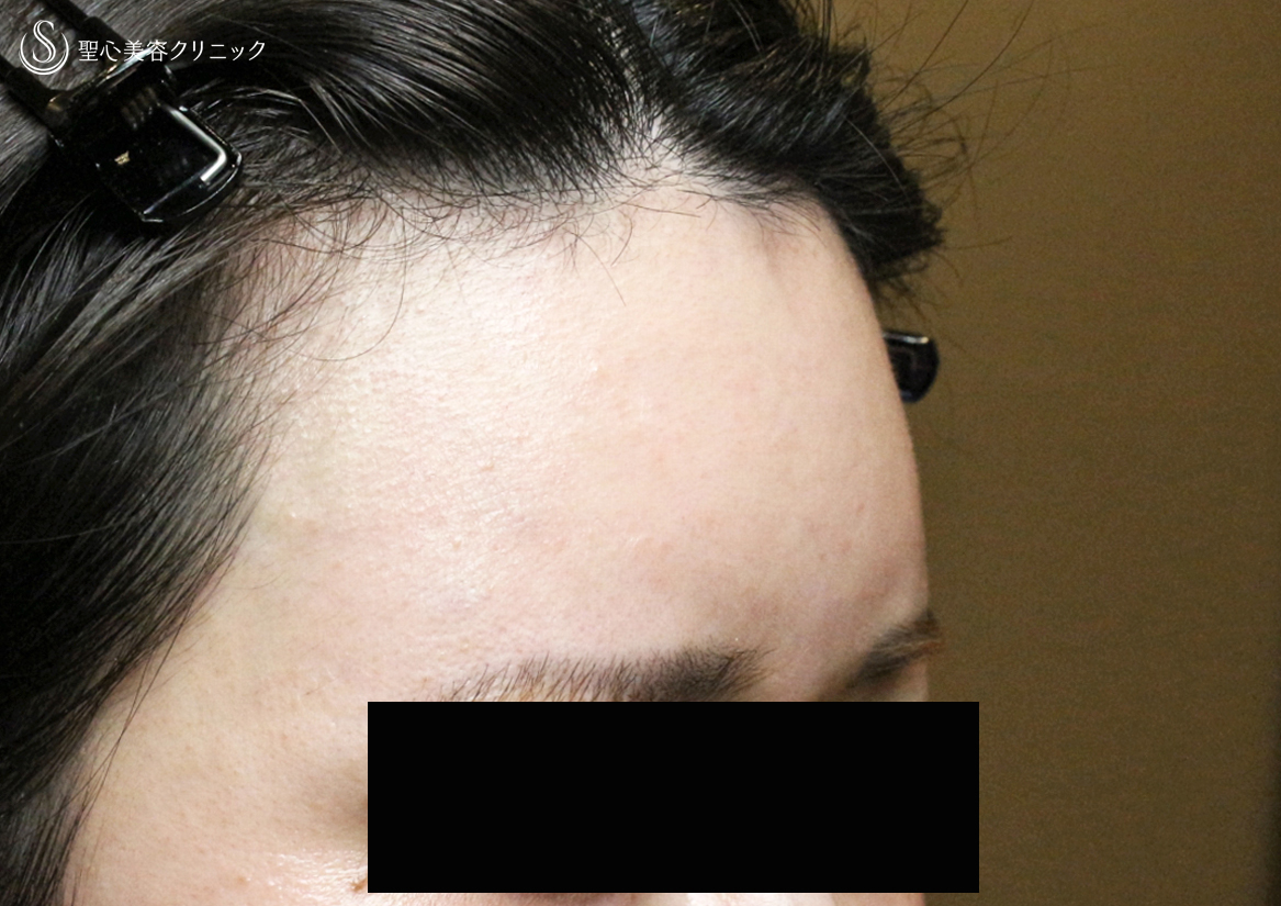 【30代女性・女性のオデコを丸くする】プレミアムPRP皮膚再生療法（直後〜3ヶ月後） Before 