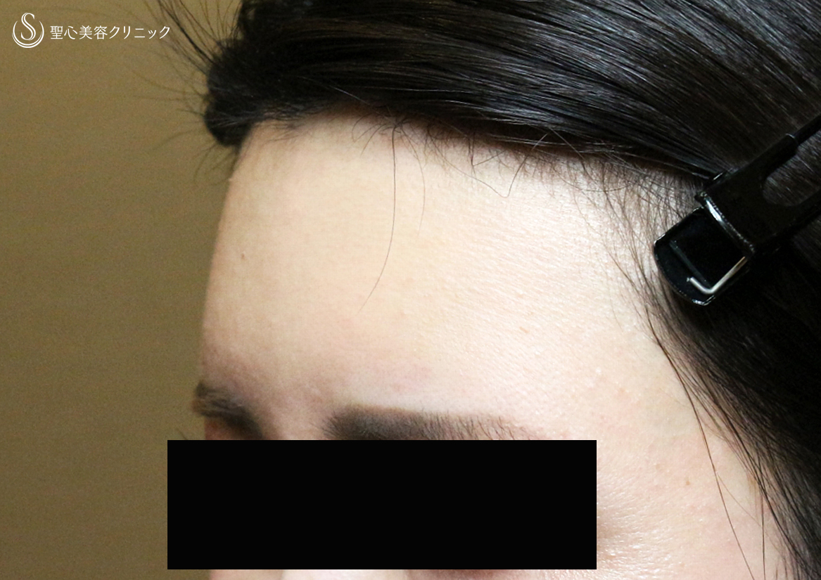 【30代女性・女性のオデコを丸くする】プレミアムPRP皮膚再生療法（直後〜3ヶ月後） After 