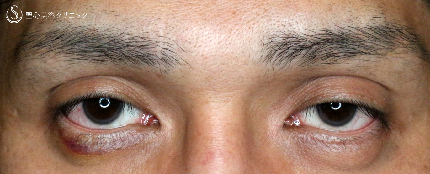 【40代男性・くぼみ目＆眼瞼下垂】切らない眼瞼下垂+α法（1年半後） Before 