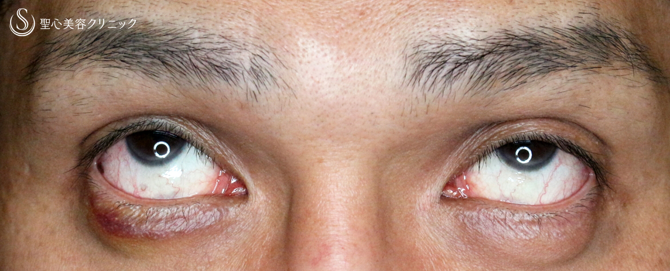 【40代男性・くぼみ目＆眼瞼下垂】切らない眼瞼下垂+α法（1年半後） Before 