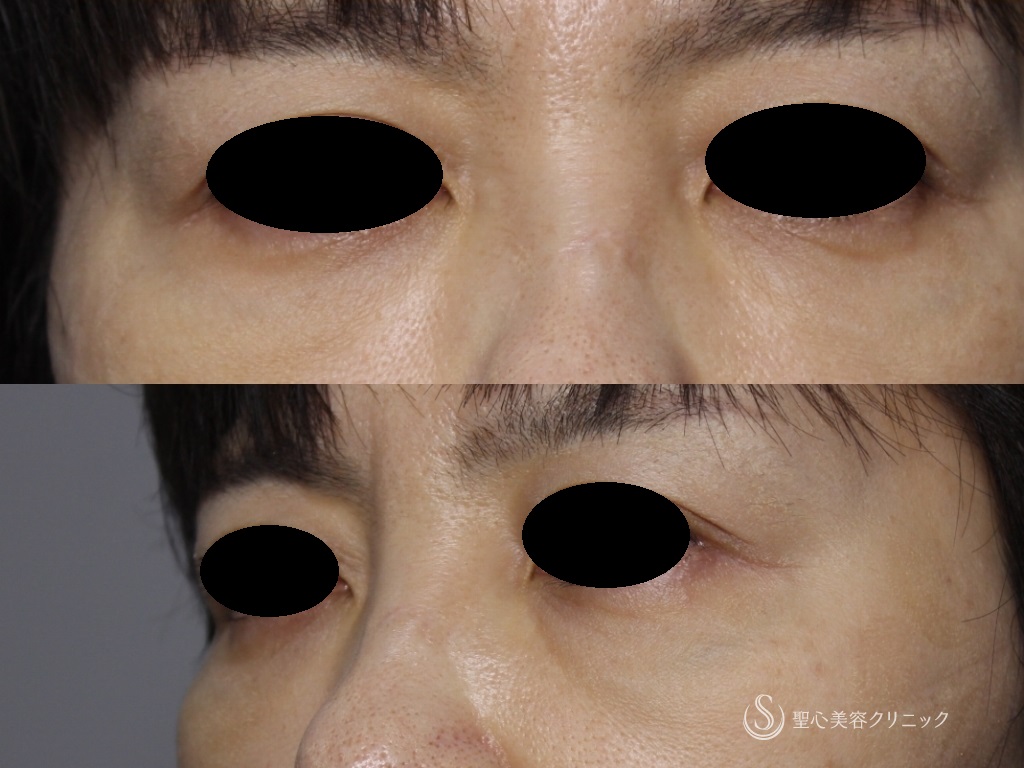 【40代女性・目の下の若返り】結膜側脱脂＋プレミアムPRP皮膚再生療法（4ヶ月後） After 