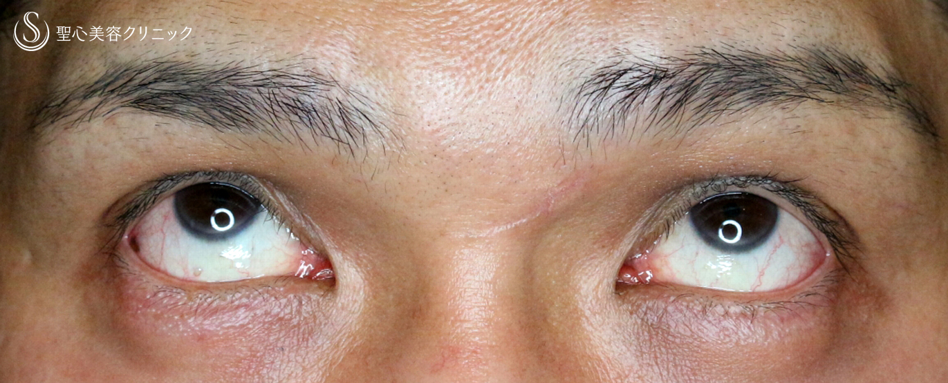 【40代男性・くぼみ目＆眼瞼下垂】切らない眼瞼下垂+α法（1年半後） After 