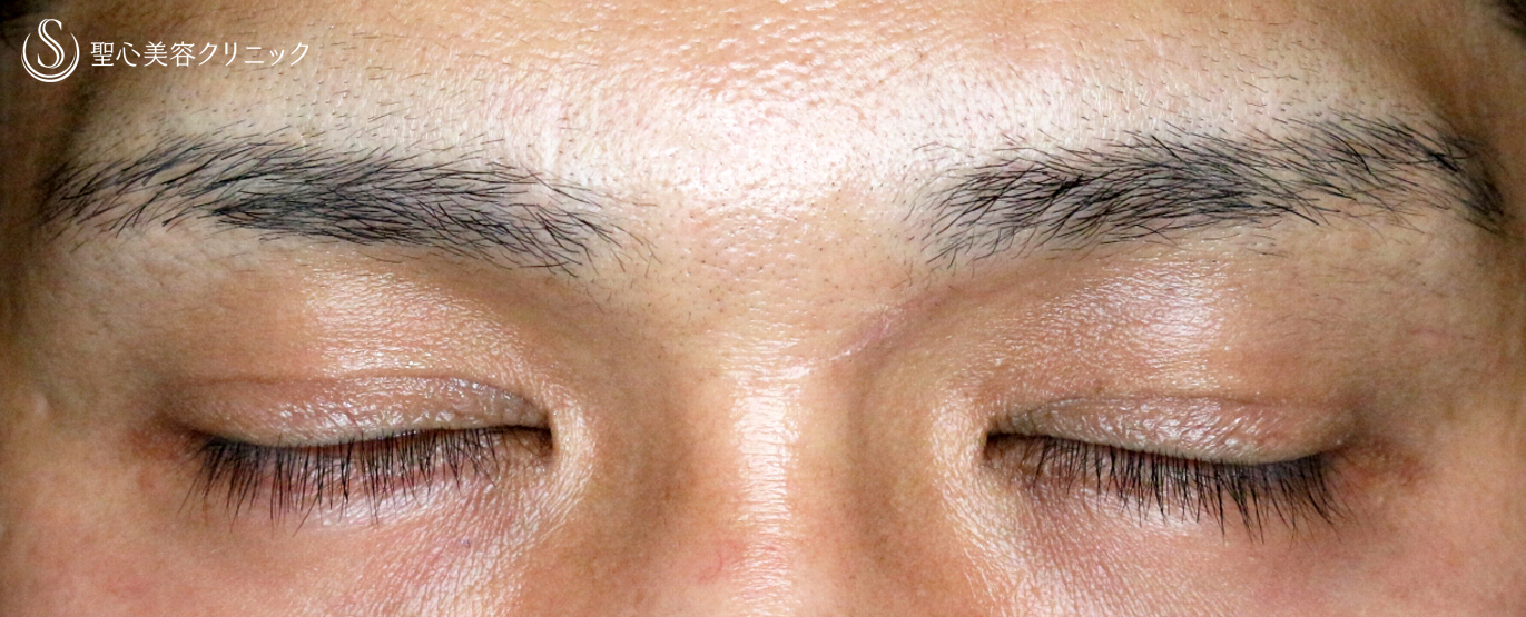 【40代男性・くぼみ目＆眼瞼下垂】切らない眼瞼下垂+α法（1年半後） After 