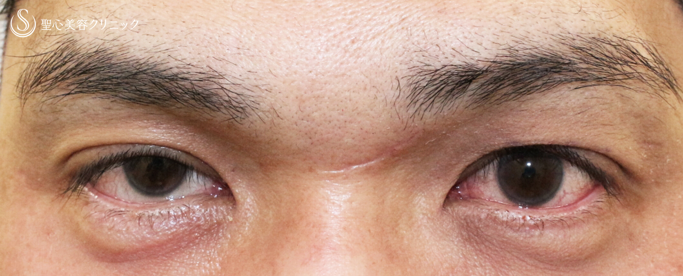 【40代男性・くぼみ目＆眼瞼下垂】切らない眼瞼下垂+α法（1年半後） After 