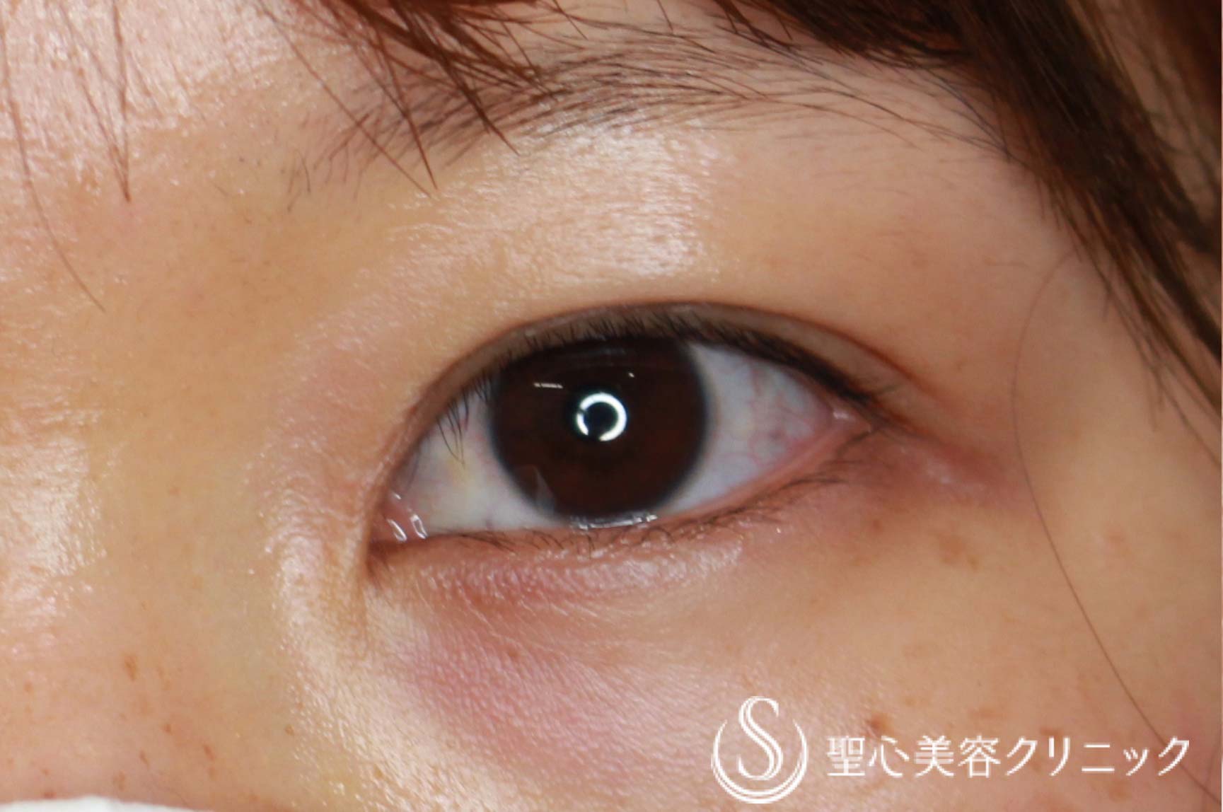 代女性 平行型二重 目上切開 二重ダブルノット法 6ヶ月後 症例写真 美容整形 美容外科なら聖心美容クリニック 代女性 平行型二重 目上切開 二重ダブルノット法 6ヶ月後 症例写真 美容整形 美容外科なら聖心美容クリニック