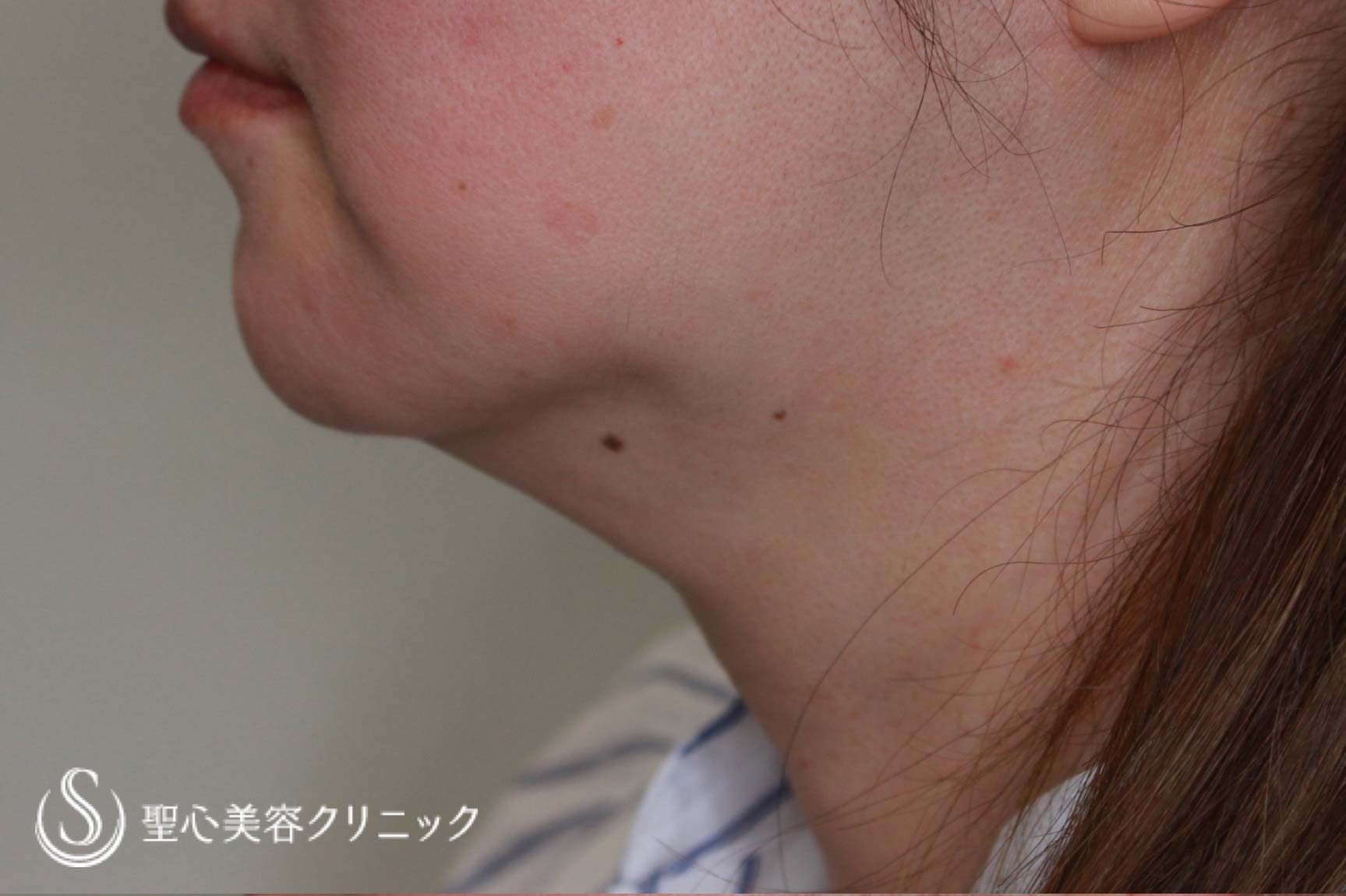【50代女性・顎下をすっきり】ベイザーリポ2.2脂肪吸引（7日後） Before 