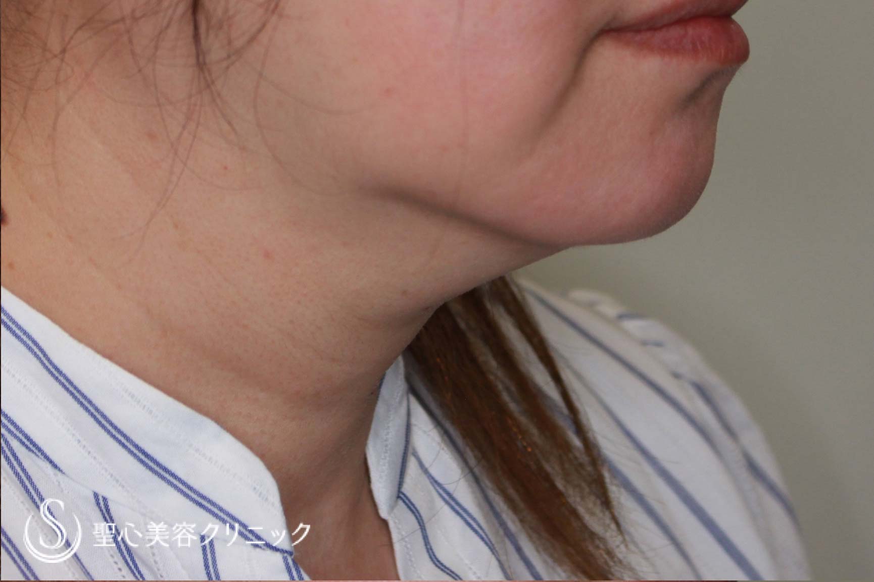 【50代女性・顎下をすっきり】ベイザーリポ2.2脂肪吸引（7日後） Before 