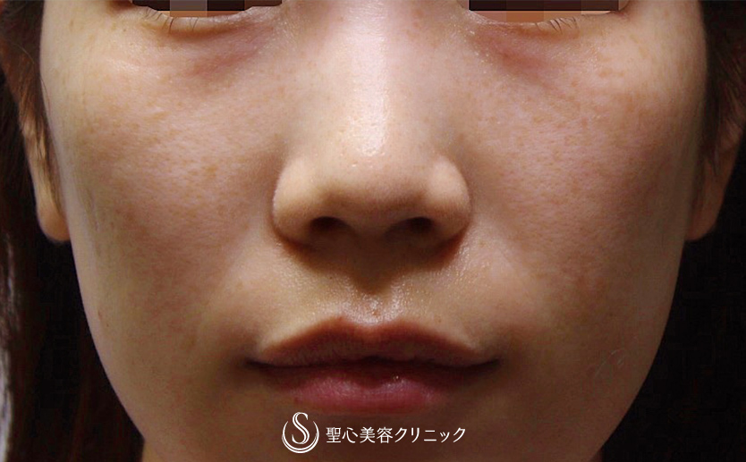 【20代女性・切らない目の下のクマ治療】プレミアムPRP皮膚再生療法（3ヶ月後） Before 