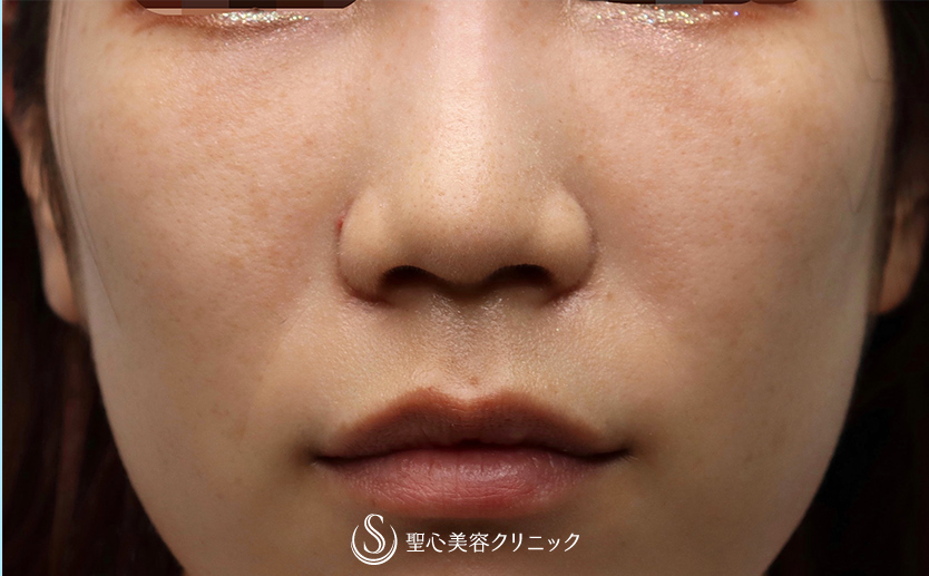 【20代女性・切らない目の下のクマ治療】プレミアムPRP皮膚再生療法（3ヶ月後） After 