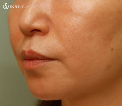 【50代女性・ほうれい線】プレミアムPRP皮膚再生療法（7年後） After 
