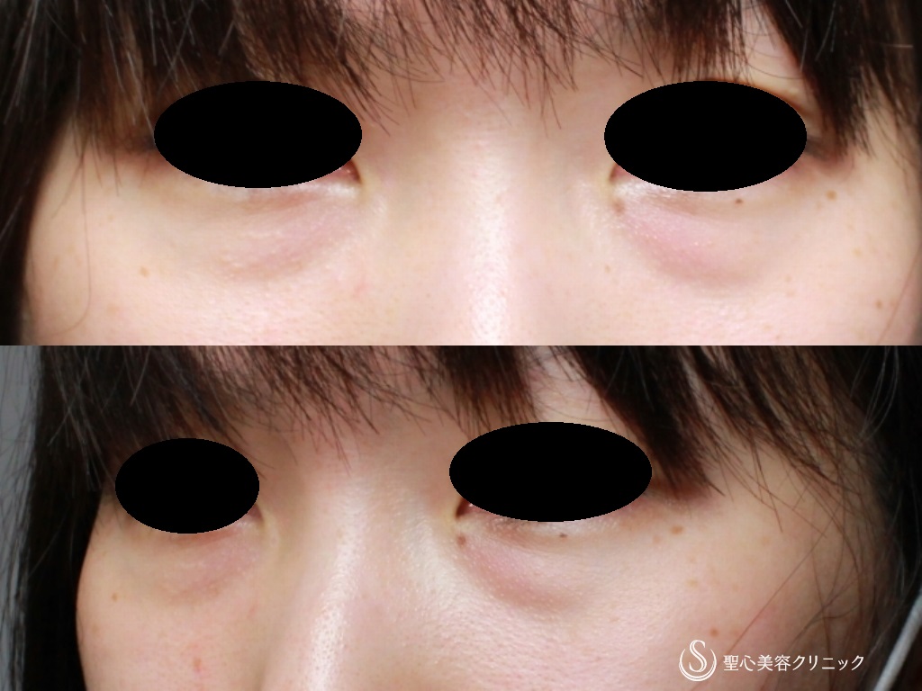 【30代女性・目の下の若返り】プレミアムPRP皮膚再生療法（9ヶ月後） Before 