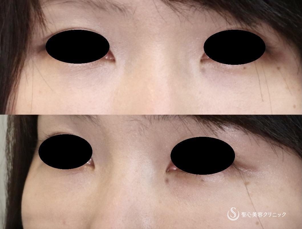 【30代女性・目の下の若返り】プレミアムPRP皮膚再生療法（9ヶ月後） After 