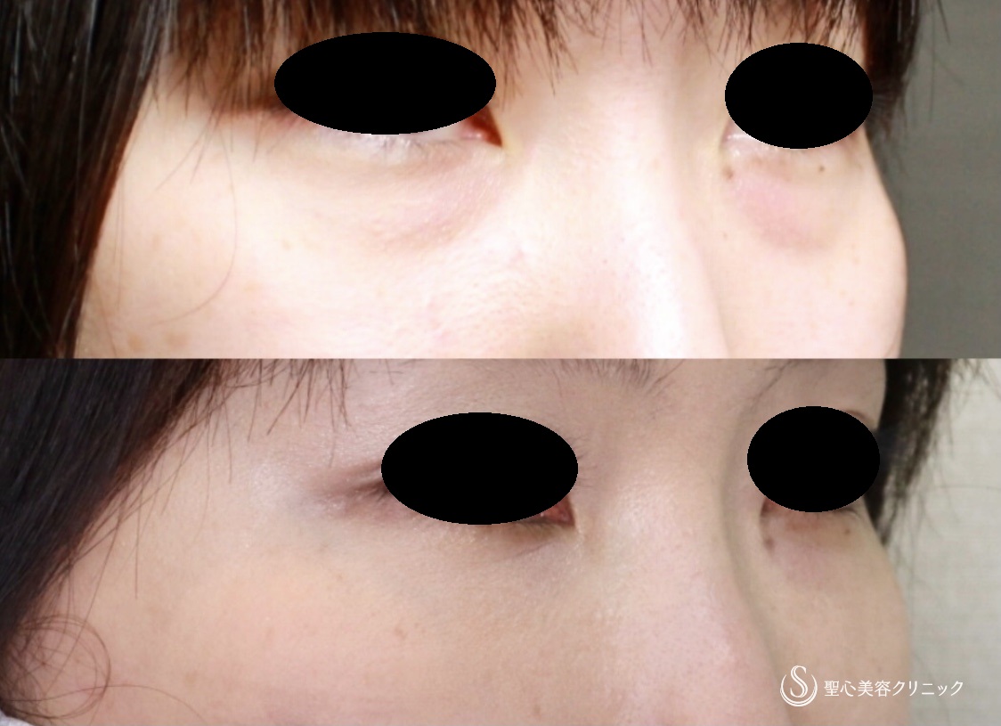 【30代女性・目の下の若返り】プレミアムPRP皮膚再生療法（9ヶ月後） After 
