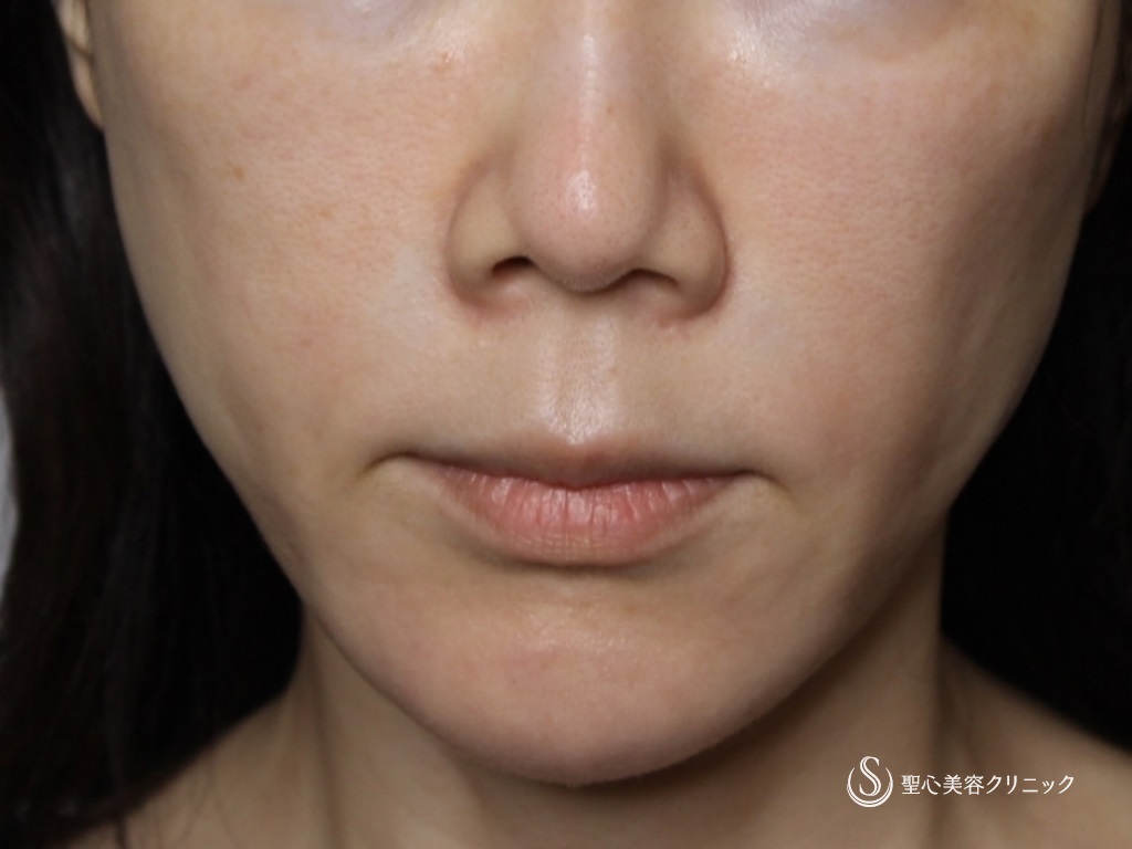 【40代女性・口元のたるみと頬の凹みを改善】アンカーマックス（糸リフト）（1ヶ月後） Before 