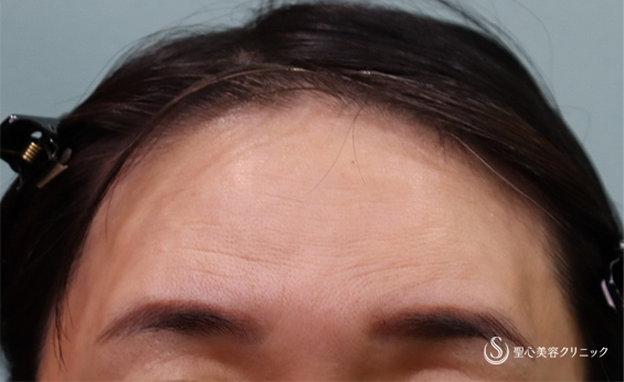 【40代女性・額、こめかみ、ほうれい線】プレミアムPRP皮膚再生療法（3ヶ月後） Before 