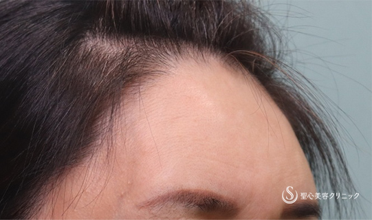 【40代女性・額、こめかみ、ほうれい線】プレミアムPRP皮膚再生療法（3ヶ月後） After 