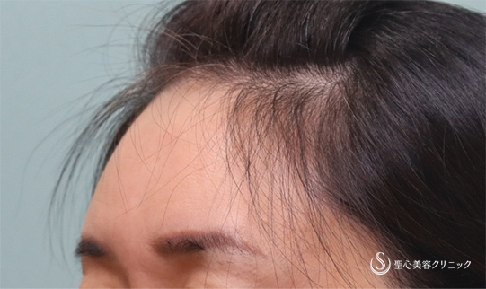 【40代女性・額、こめかみ、ほうれい線】プレミアムPRP皮膚再生療法（3ヶ月後） After 