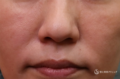 【40代女性・額、こめかみ、ほうれい線】プレミアムPRP皮膚再生療法（3ヶ月後） Before 