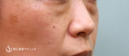 【40代女性・目の下のクマ】プレミアムPRP皮膚再生療法（1ヶ月後） Before 