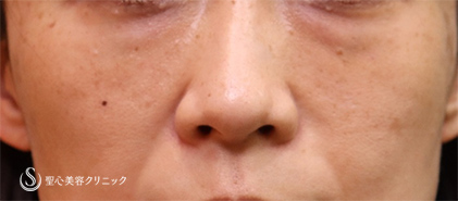 【40代女性・目の下のクマ】プレミアムPRP皮膚再生療法（1ヶ月後） After 