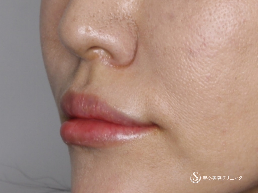 【40代女性・鼻下を短く】リップリフト（鼻下短縮術）（術後2か月） Before 