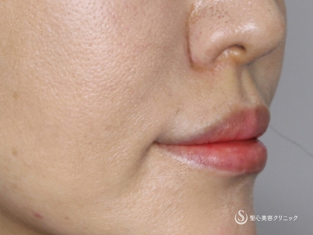 【40代女性・鼻下を短く】リップリフト（鼻下短縮術）（術後2か月） Before 