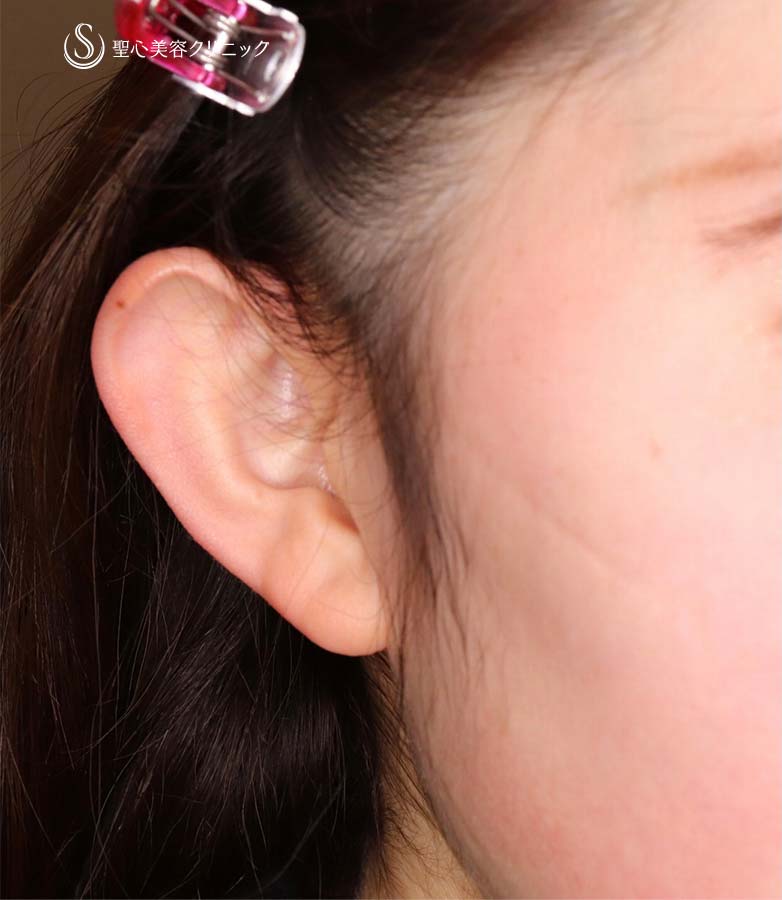 【20代女性・立ち耳を改善！！】立ち耳修正（埋没法）（術直後） Before 