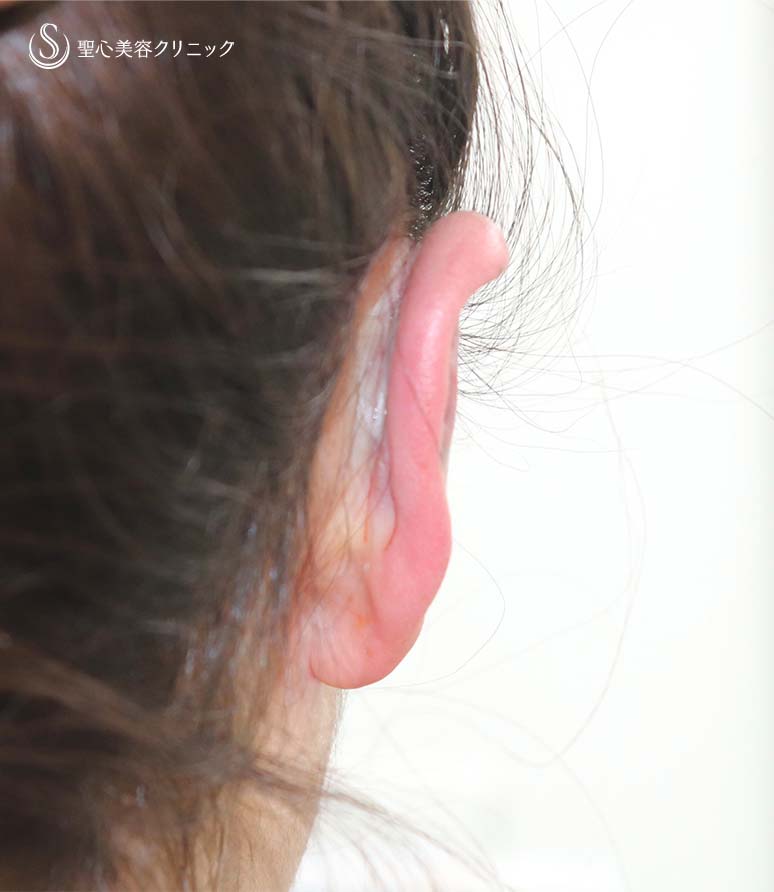 【20代女性・立ち耳を改善！！】立ち耳修正（埋没法）（術直後） After 