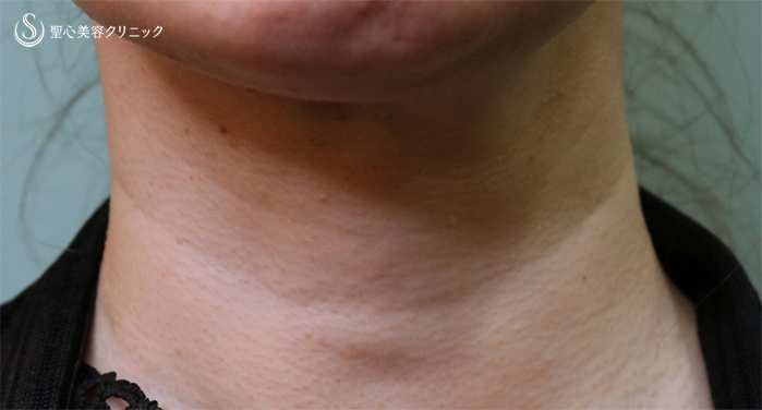 【40代女性・首のしわ】プレミアムPRP皮膚再生療法（術後11カ月） Before 