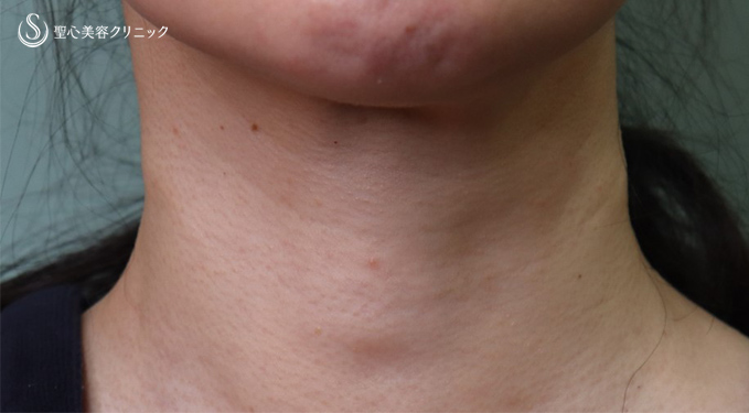 【40代女性・首のしわ】プレミアムPRP皮膚再生療法（術後11カ月） After 