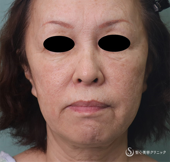 【60代女性・フェイスラインのたるみ】フェイスリフト（術後1か月） Before 
