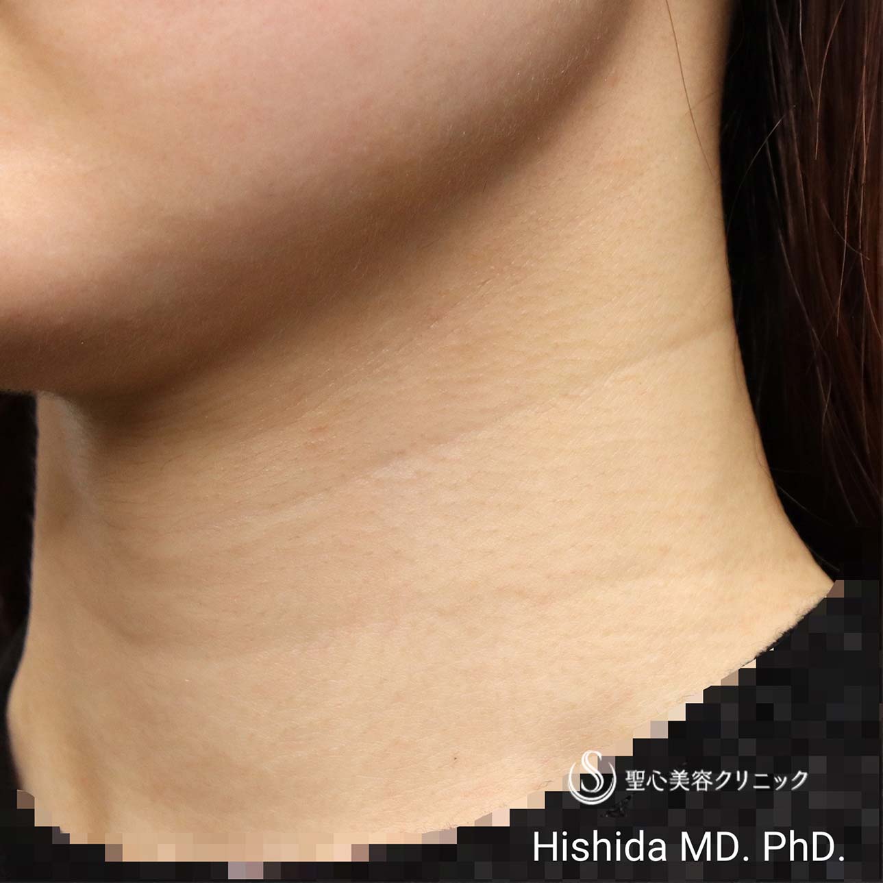 【30代女性・首の横ジワを治したい】プレミアムPRP皮膚再生療法（2ヶ月後） Before 