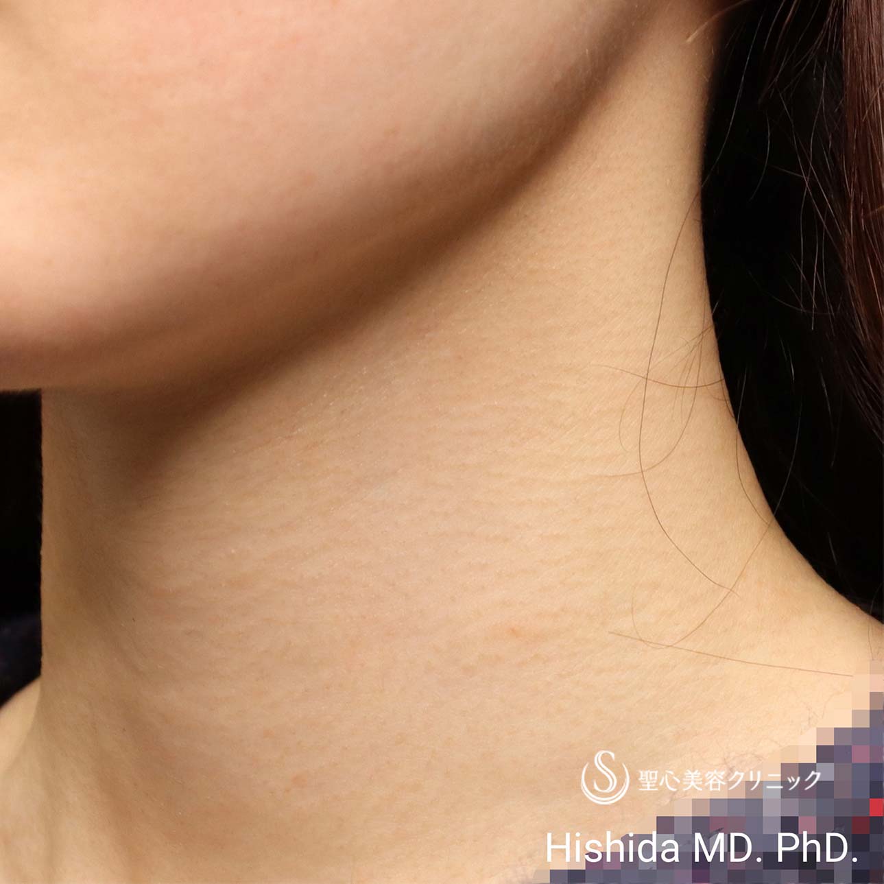 【30代女性・首の横ジワを治したい】プレミアムPRP皮膚再生療法（2ヶ月後） After 