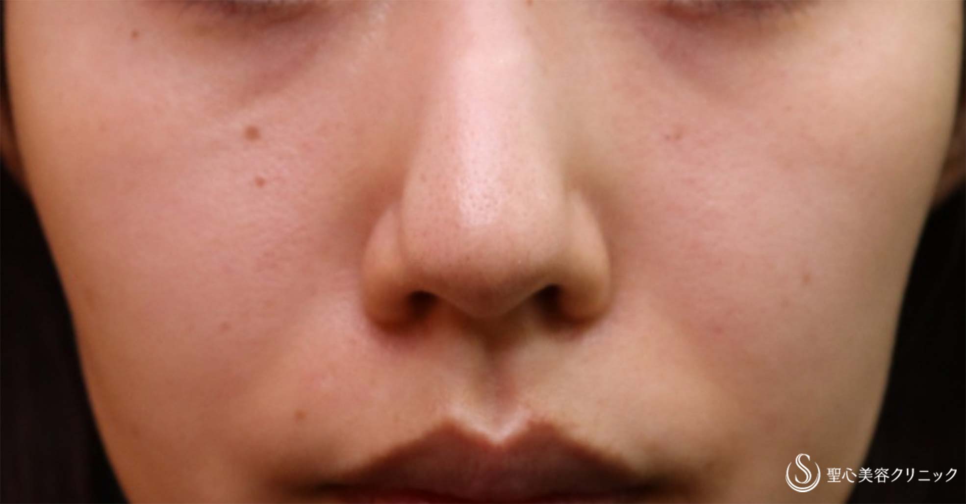 【30代女性・目の下＆ほうれい線】プレミアムPRP皮膚再生療法（4か月半後） Before 