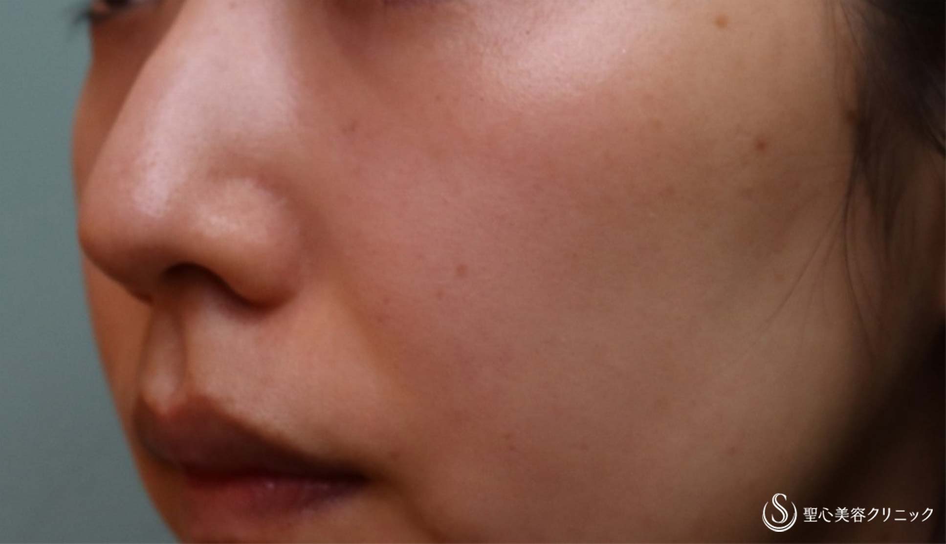 【30代女性・目の下＆ほうれい線】プレミアムPRP皮膚再生療法（4か月半後） Before 