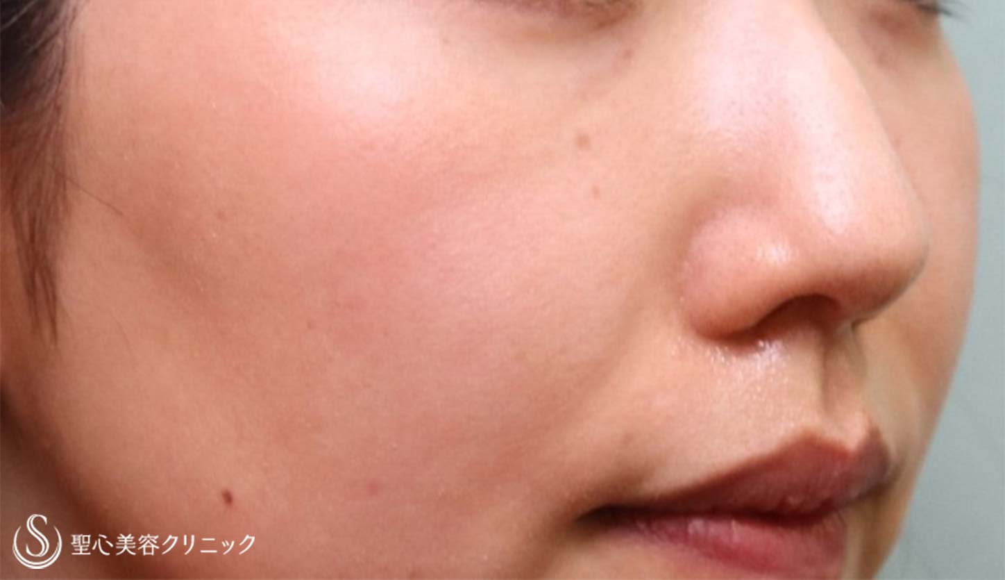【30代女性・目の下＆ほうれい線】プレミアムPRP皮膚再生療法（4か月半後） After 