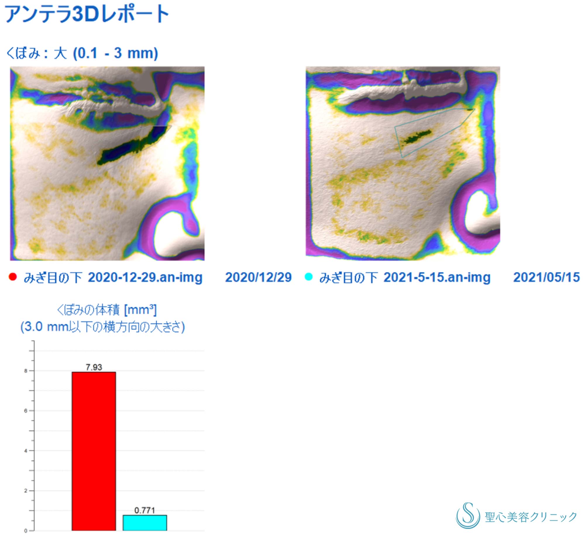 【30代女性・目の下＆ほうれい線】プレミアムPRP皮膚再生療法（4か月半後） After 