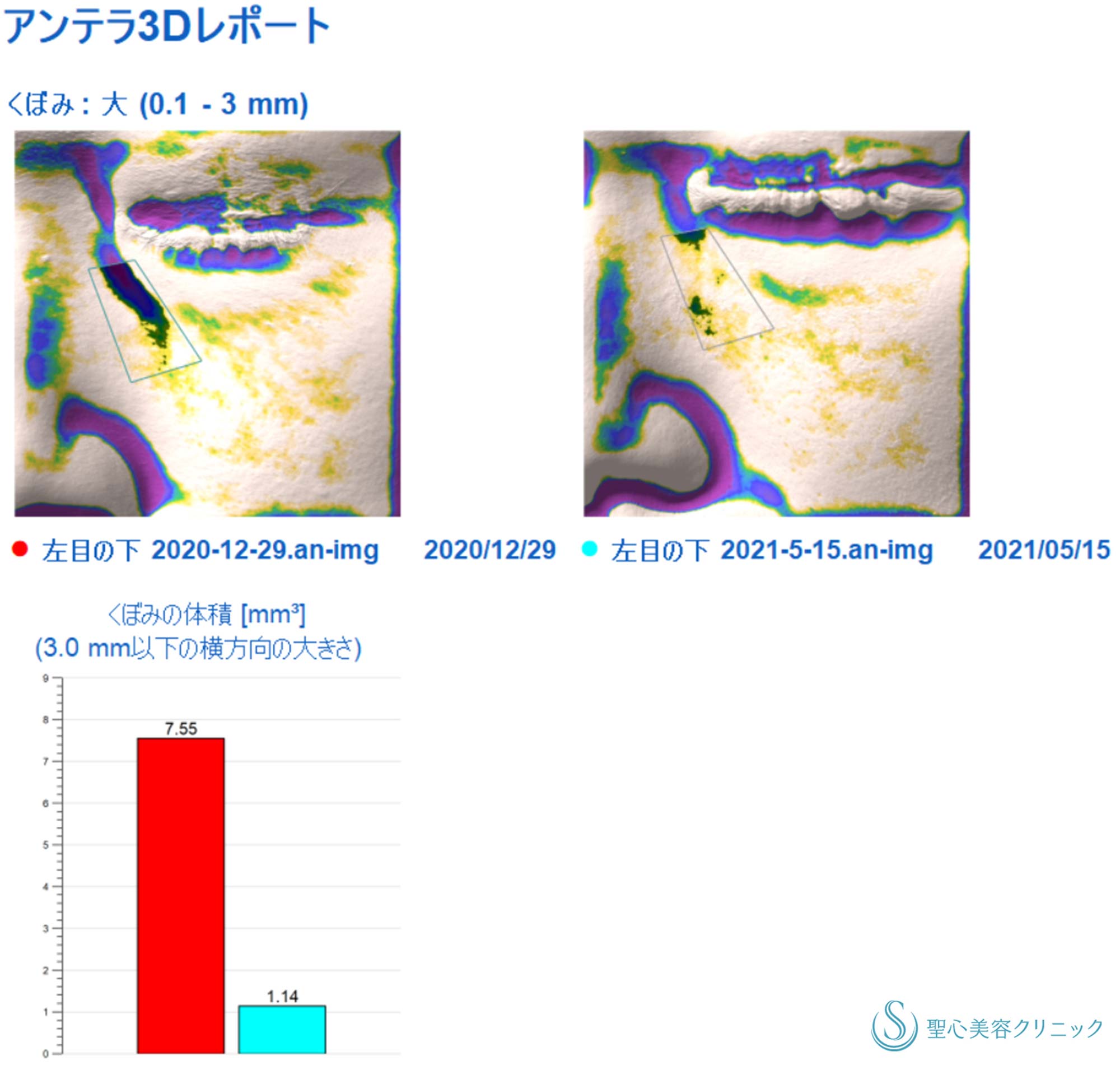 【30代女性・目の下＆ほうれい線】プレミアムPRP皮膚再生療法（4か月半後） After 