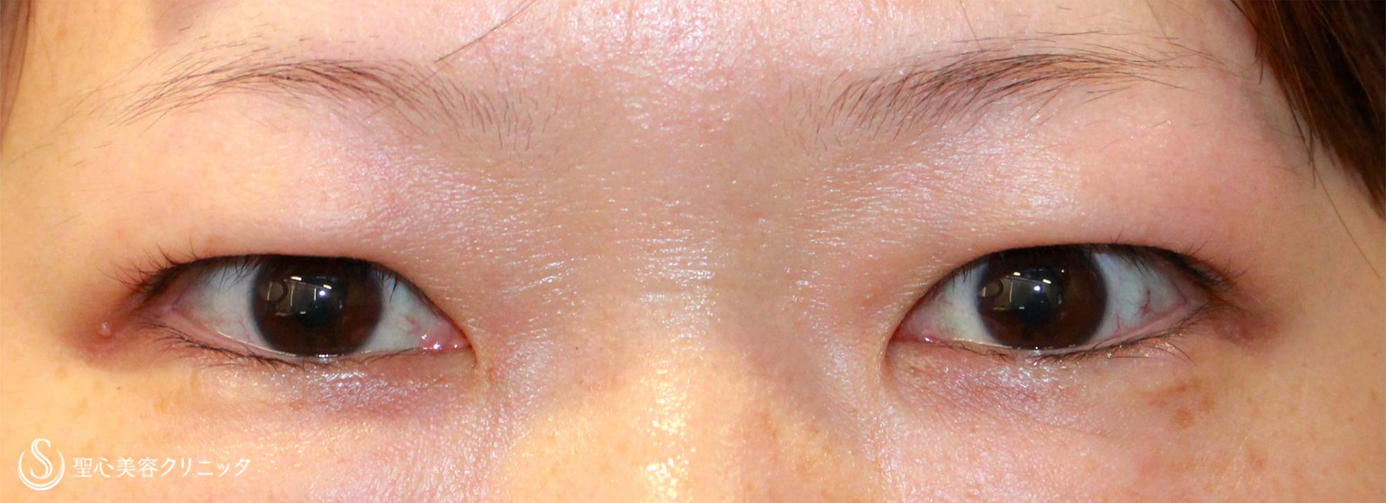 【40代女性・華やかで若い瞼に】眉下切開法（術後１年） Before 