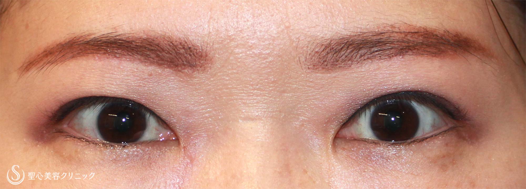【40代女性・華やかで若い瞼に】眉下切開法（術後１年） After 